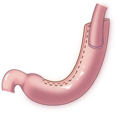 Cardia function-preserving surgery and anti-reflux anastomotic method after proximal gastrectomy for gastric cancer: Current status and future perspectives